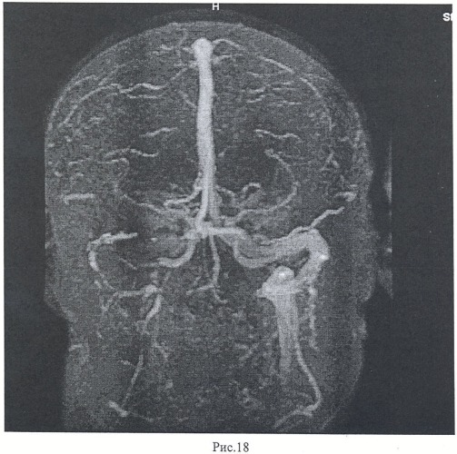 Способ визуализации сосудов головного мозга (патент 2454936)