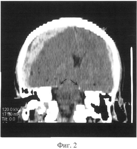 Способ определения степени височно-тенториального ущемления ствола головного мозга (патент 2503410)