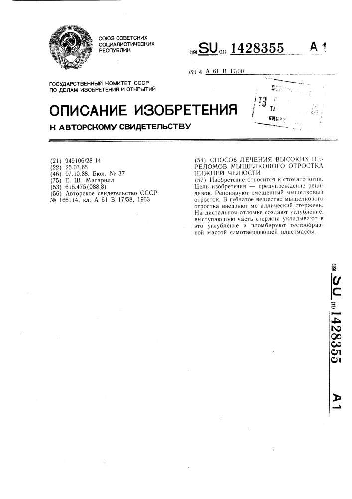 Способ лечения высоких переломов мыщелкового отростка нижней челюсти (патент 1428355)