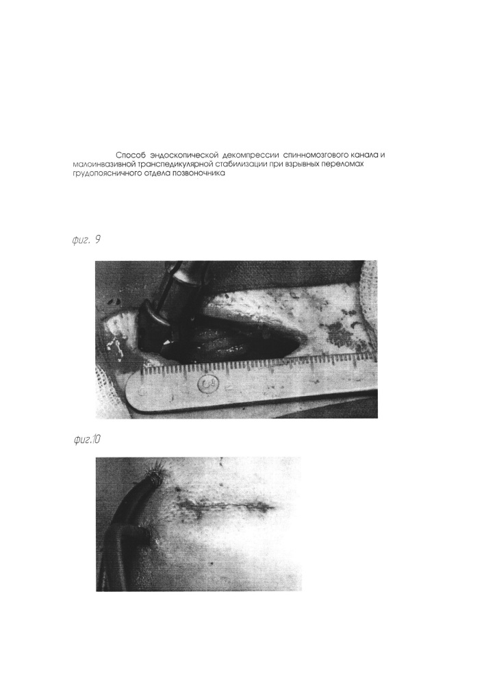 Способ эндоскопической декомпрессии спинномозгового канала и малоинвазивной транспедикулярной стабилизации при взрывных переломах грудопоясничного отдела позвоночника (патент 2649826)