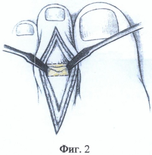 Способ межфалангового артродеза после коррекции ригидной молоткообразной деформации средних пальцев стопы (патент 2487683)