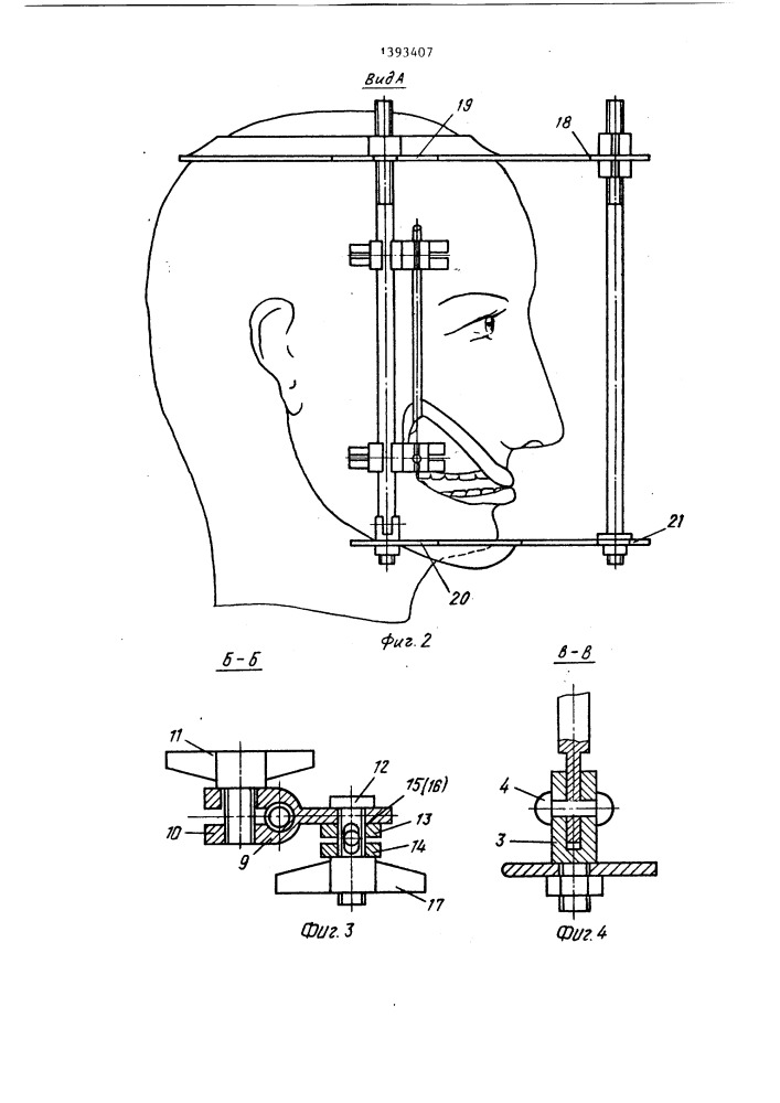 Ранорасширитель (патент 1393407)