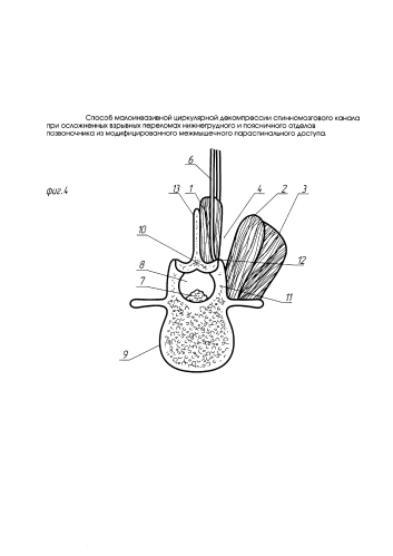 Способ малоинвазивной циркулярной декомпрессии спинномозгового канала при осложненных взрывных переломах нижнегрудного и поясничного отделов позвоночника из модифицированного межмышечного параспинального доступа (патент 2592779)