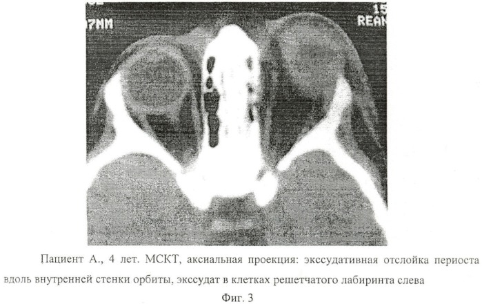 Способ хирургического лечения субпериостального абсцесса внутренней стенки орбиты (патент 2458660)