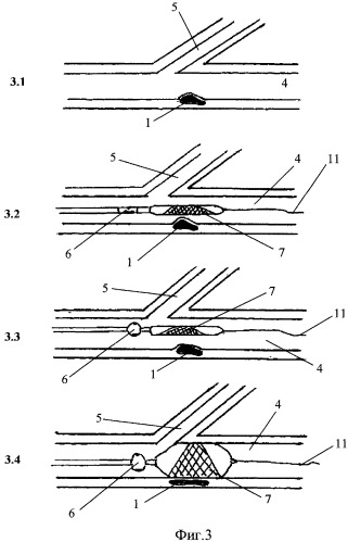 Двухбалонная система доставки усеченного стента (патент 2491038)