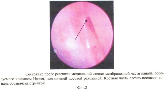 Способ хирургического лечения хронического дакриоцистита (патент 2532014)