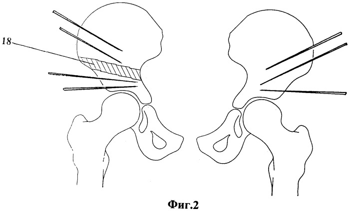 Способ лечения деформаций тазового кольца (патент 2370232)