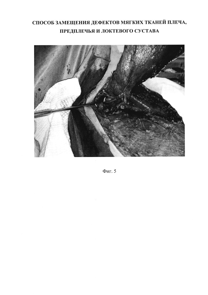 Способ замещения дефектов мягких тканей плеча, предплечья и локтевого сустава (патент 2621275)