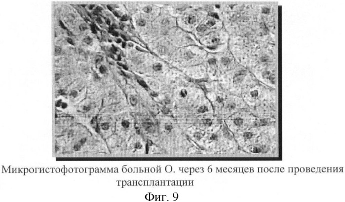 Биотрансплантат, способ лечения хронических заболеваний печени и способ лечения цирроза печени и портальной гипертензии (патент 2368384)