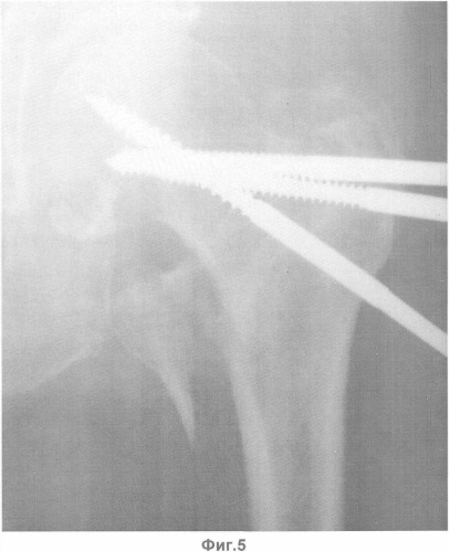 Способ лечения нестабильных оскольчатых внесуставных переломов проксимального отдела бедренной кости (патент 2361535)