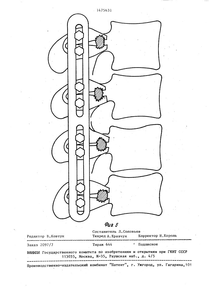 Фиксатор позвоночника (патент 1475631)