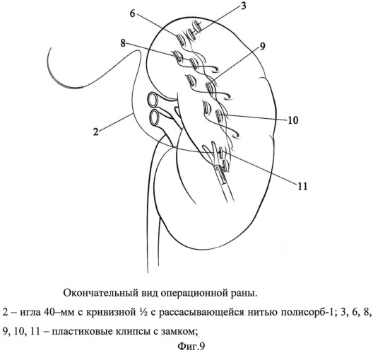 Способ ушивания раны почки при лапароскопическом органосохраняющем лечении рака почки в условиях тепловой ишемии (патент 2532897)