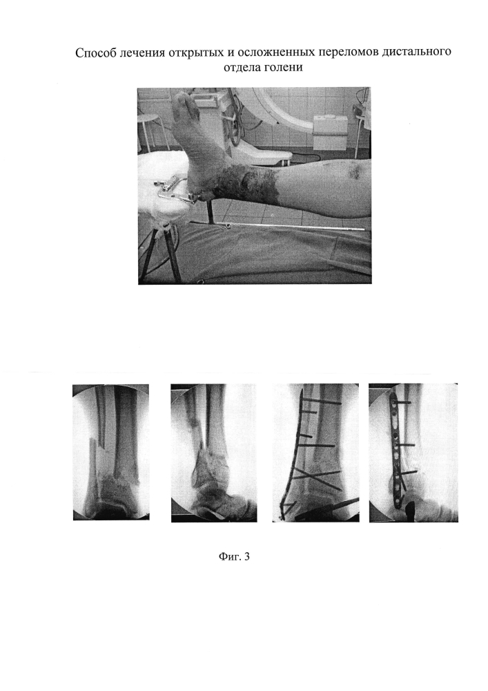 Способ лечения открытых и осложненных переломов дистального отдела голени (патент 2605647)