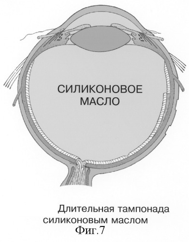 Способ электрохимической деструкции, хирургического удаления и фотодинамической профилактики рецидивов внутриглазных новообразований (варианты) (патент 2244531)