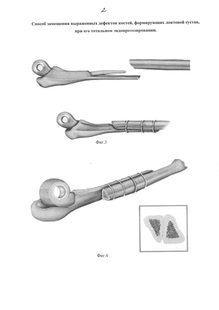 Способ замещения выраженных дефектов костей, формирующих локтевой сустав, при его тотальном эндопротезировании (патент 2662899)