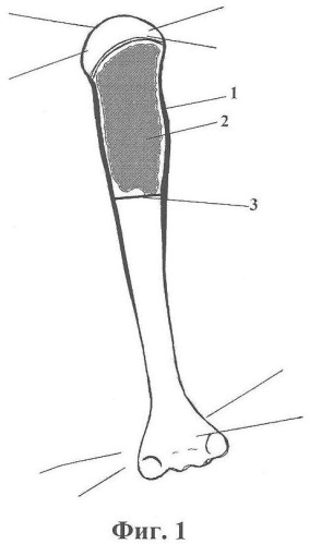Способ лечения костных кист и опухолей длинных трубчатых костей (патент 2355349)