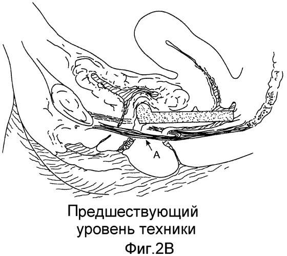 Коррекция стрессового недержания мочи (патент 2548825)