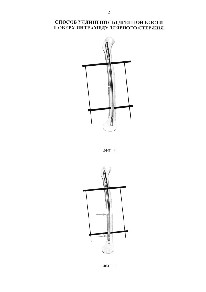 Способ удлинения бедренной кости поверх интрамедуллярного стержня (патент 2638279)