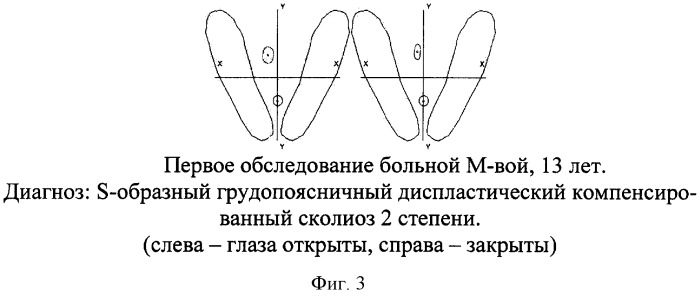 Способ прогнозирования прогрессирования сколиотической деформации (патент 2302818)