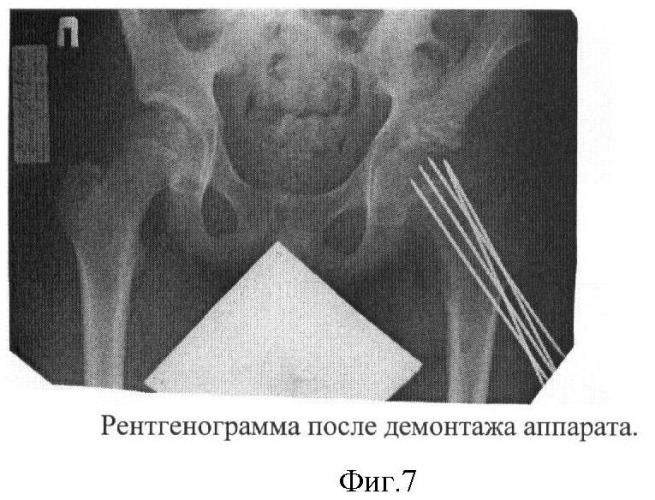 Способ лечения юношеского эпифизиолиза головки бедренной кости у детей (патент 2422110)