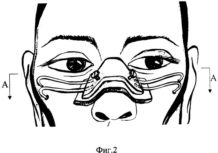 Конструкция для жесткой фиксации костей носа (патент 2274428)