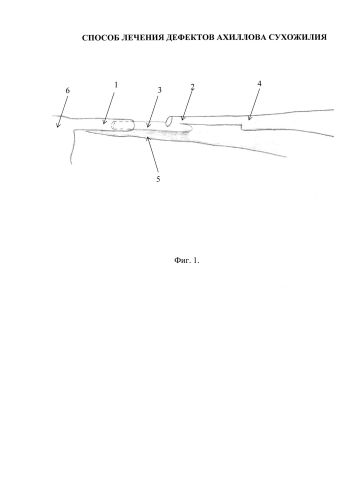 Способ лечения дефектов ахиллова сухожилия (патент 2588491)