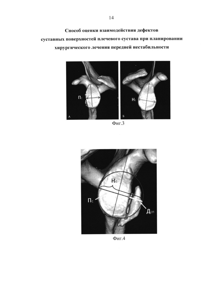 Способ оценки взаимодействия дефектов суставных поверхностей плечевого сустава при планировании хирургического лечения передней нестабильности (патент 2661717)