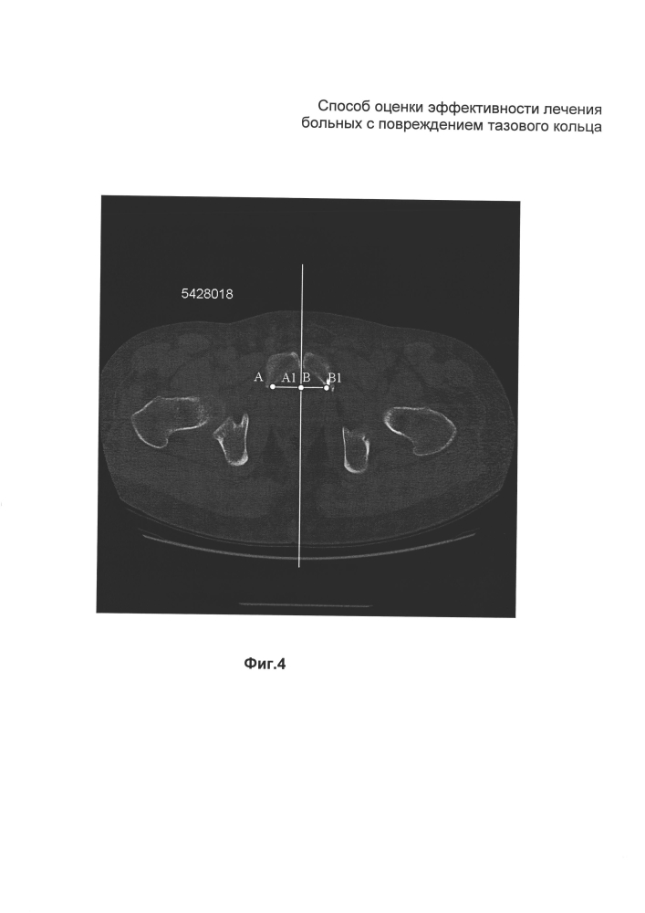 Способ оценки эффективности лечения больных с повреждением тазового кольца (патент 2600221)