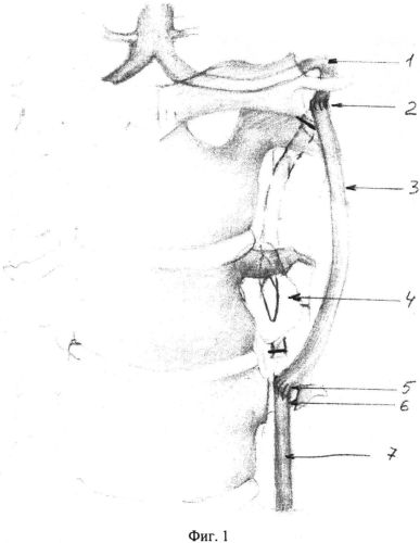 Способ хирургического лечения аневризматического поражения позвоночной артерии на шейном уровне (патент 2558457)