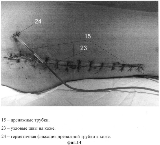 Способ лечения хронического остеомиелита длинных костей конечностей (патент 2544303)