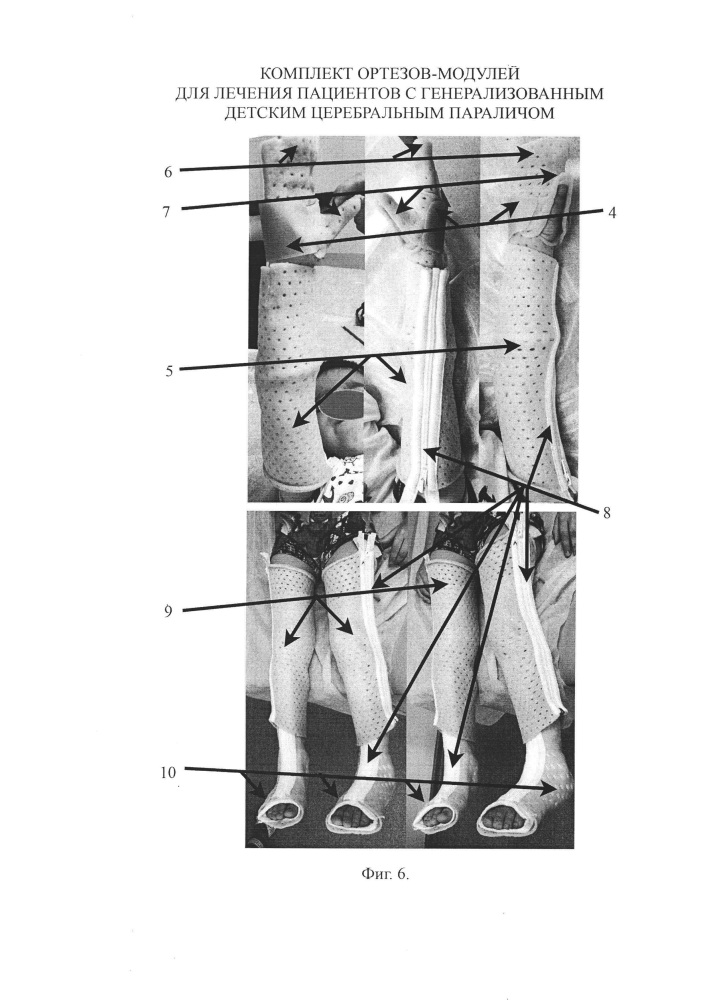 Комплект модулей-ортезов для лечения пациентов с генерализованным детским церебральным параличом (патент 2659845)