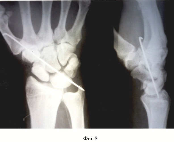 Способ вправления застарелого вывиха полулунной кости кисти (патент 2483686)