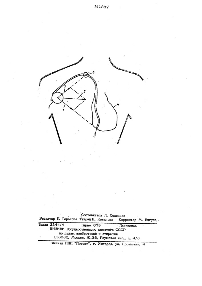 Способ определения повреждения имплантированного эидокардиального электрода (патент 741887)