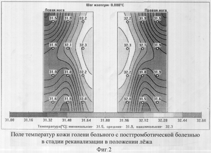 Способ комбинированной термометрии для диагностики посттромботической болезни вен нижних конечностей (патент 2319438)