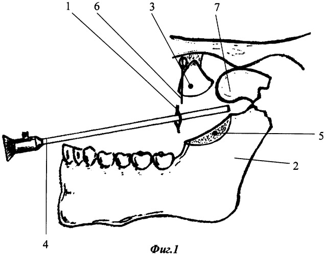 Метод внутриротового остеосинтеза под видеоэндоскопическим контролем при переломах мыщелкового отростка нижней челюсти с вывихом головки в подвисочную ямку (патент 2311143)