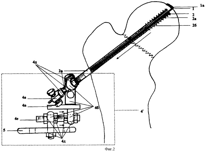 Устройство для остеосинтеза медиальных переломов шейки бедренной кости (патент 2337645)