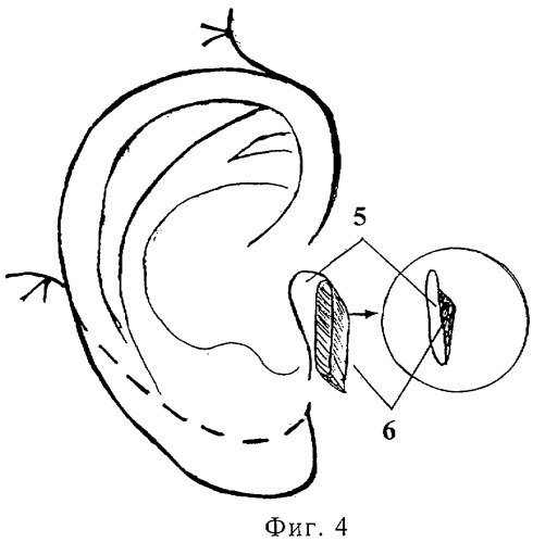 Способ формирования козелка ушной раковины (патент 2284764)