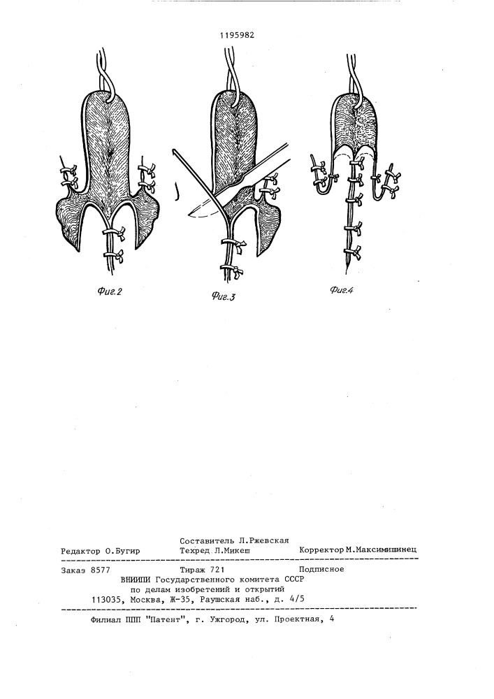 Способ велофарингопластики (патент 1195982)