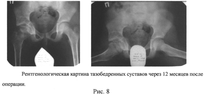 Способ выполнения периацетабулярной тройной остеотомии таза у подростков (патент 2556788)
