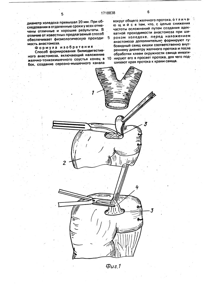 Способ формирования билиодигестивного анастомоза (патент 1718838)