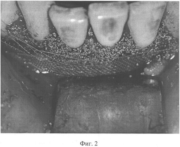 Способ хирургического лечения хронических пародонтитов (патент 2355353)