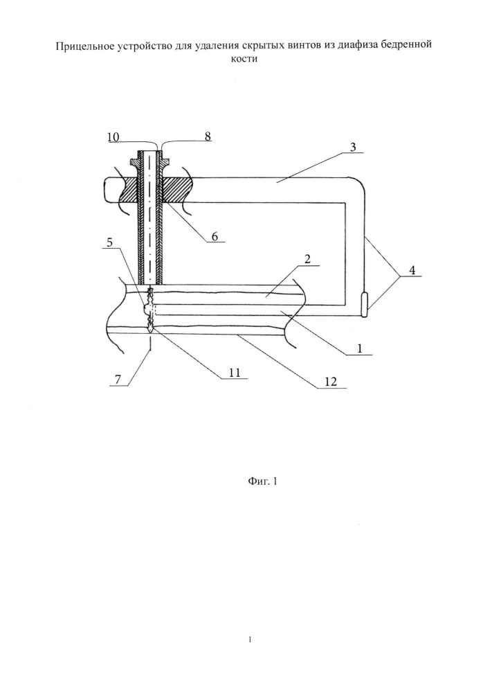 Прицельное устройство для удаления скрытых винтов из диафиза бедренной кости (патент 2614496)