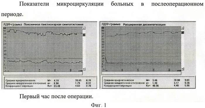 Способ комбинированной десимпатизации у больных с хронической ишемией нижних конечностей (патент 2441603)