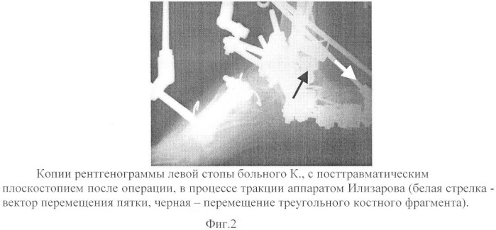 Способ устранения посттравматического плоскостопия (патент 2413474)