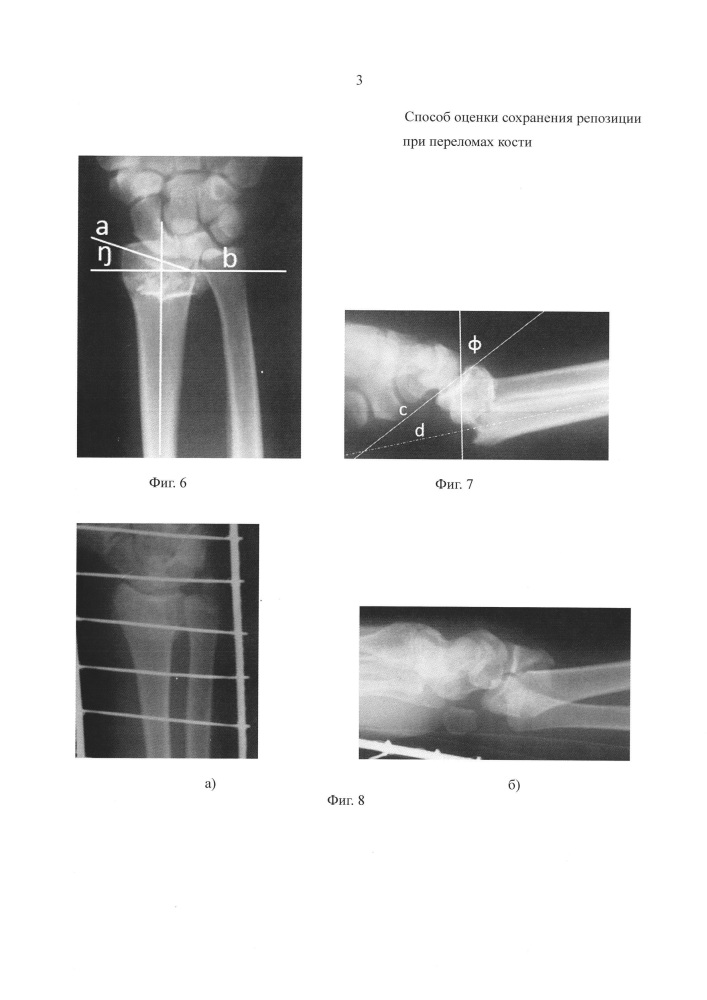 Способ оценки сохранения репозиции переломов костей (патент 2626375)