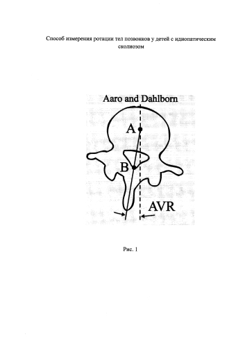 Способ измерения ротации тел позвонков у детей с идиопатическим сколиозом (патент 2587035)