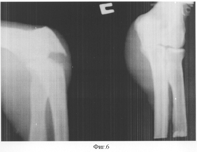 Способ лечения многооскольчатых переломов локтевой кости (патент 2306892)