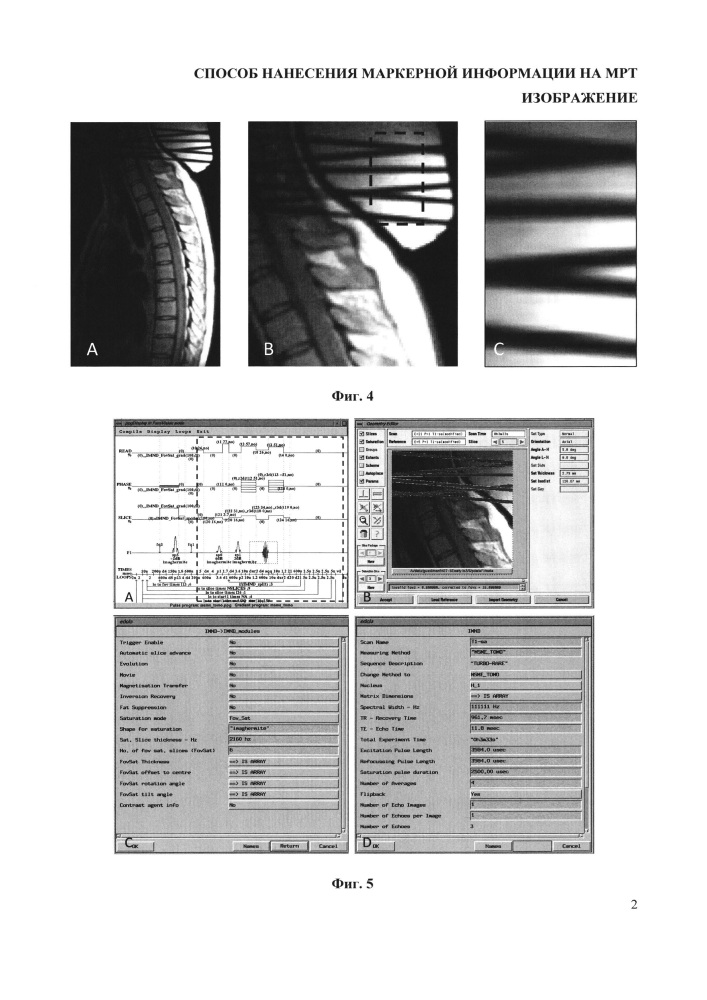 Способ нанесения маркерной информации на мрт изображение (патент 2664169)