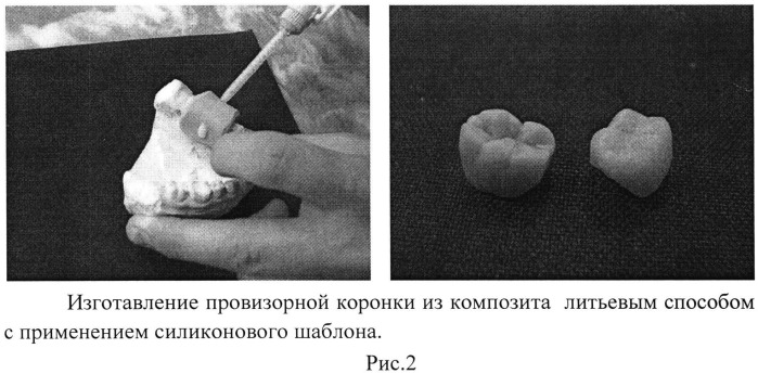 Способ изготовления временных коронок (патент 2534404)