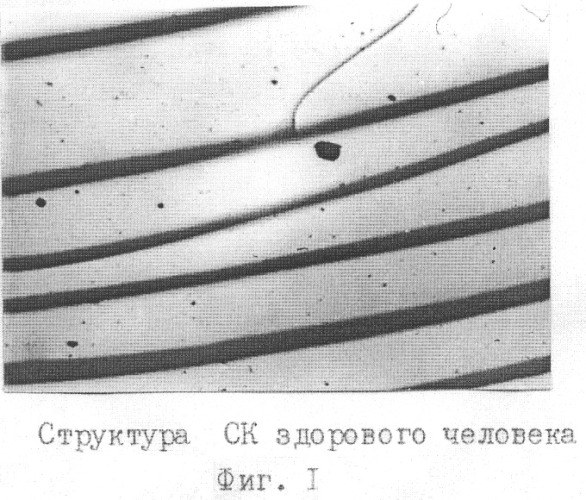 Способ экспресс-диагностики гипер-бета 2-микроглобулинемии (патент 2259565)